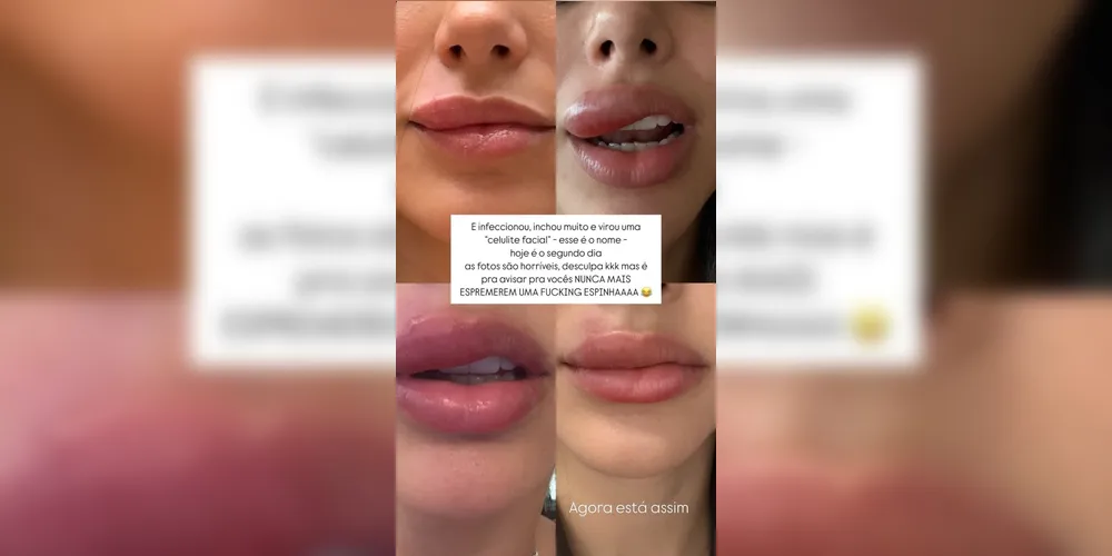 Bruna Biancardi assustou ao mostrar inchaço na boca