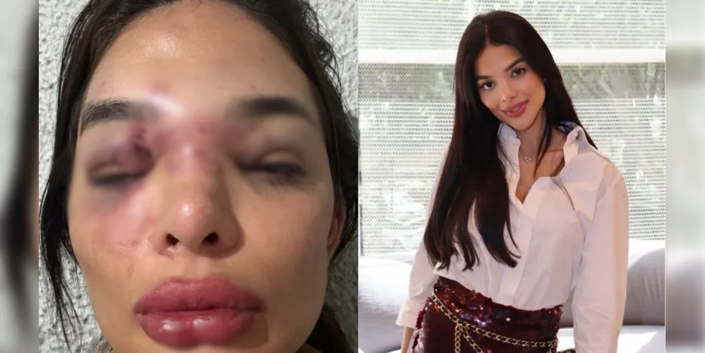 Giullia Kos mostrou o rosto desfigurado após agressos nas redes sociais