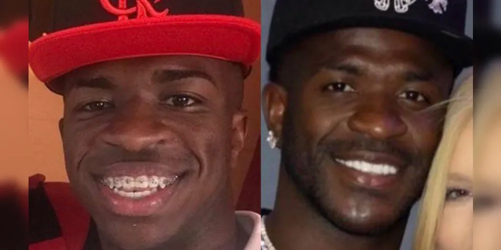 Antes e depois da harmonização facial de Vini Jr