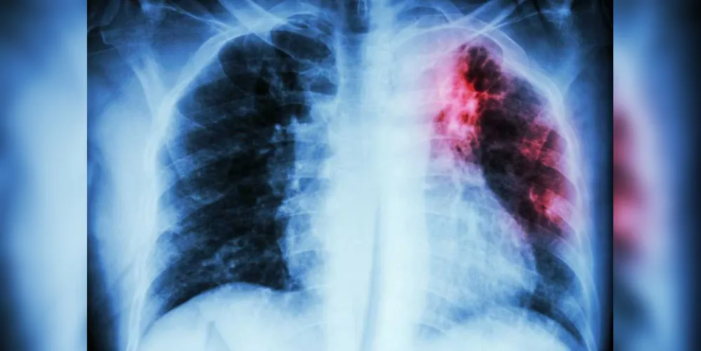 Imagem ilustrativa da imagem Tuberculose mata 4,5 mil pessoas por ano no Brasil