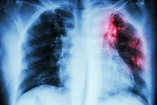 Imagem ilustrativa da imagem Tuberculose mata 4,5 mil pessoas por ano no Brasil