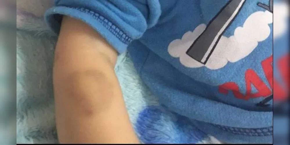 Entre as várias lesões, marca de mordida em braço da criança causa repulsa