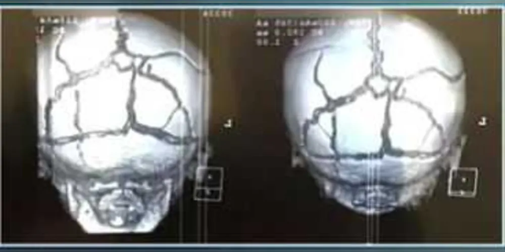 Imagem de raio x mostrando fraturas de crânio da criança impressiona e provoca revolta