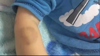 Entre as várias lesões, marca de mordida em braço da criança causa repulsa