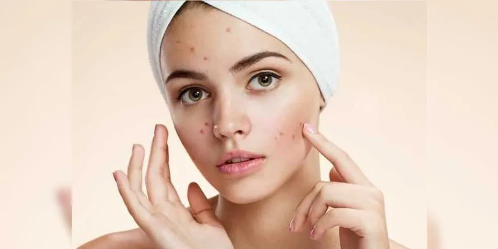 Imagem ilustrativa da imagem Sofre com acne? Dermatologista esclarece dúvidas mais comuns