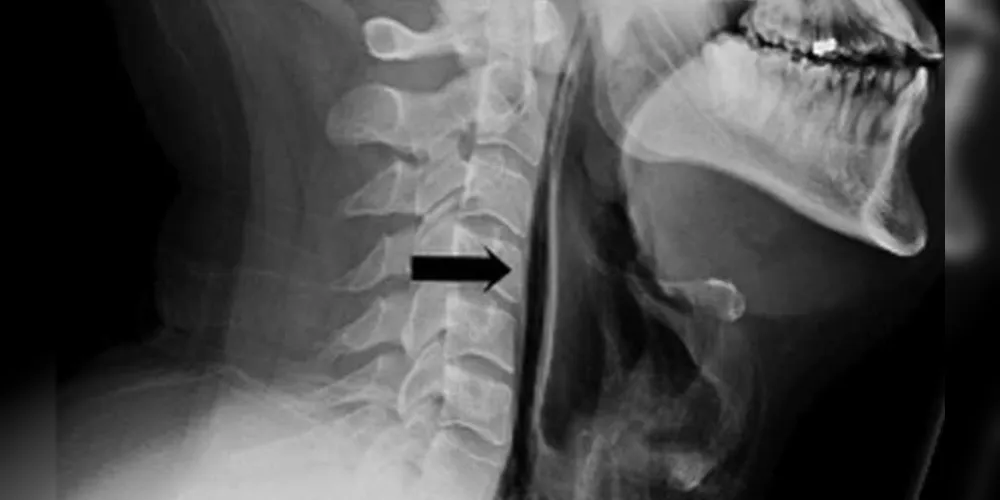 A flecha indica a fratura da garganta/Foto: Divulgação BMJ