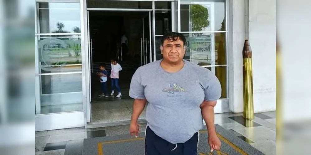 Alejandro Ramos, o 'Willy', convive com seu corpo inchado há quatro anos/Foto: Divulgação BBC Brasil 
