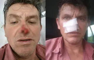 Imagem ilustrativa da imagem Homem tem nariz deformado após mordida em baile