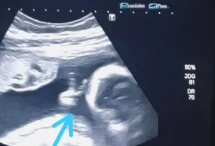 o bebê fez um ‘V de vitória’ com a mãozinha, dentro do útero