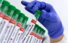Região registra o primeiro caso de Varíola dos Macacos