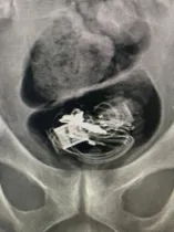 Em raio-X foi contato que no intestino do homem havia um fone de ouvido e pen drive