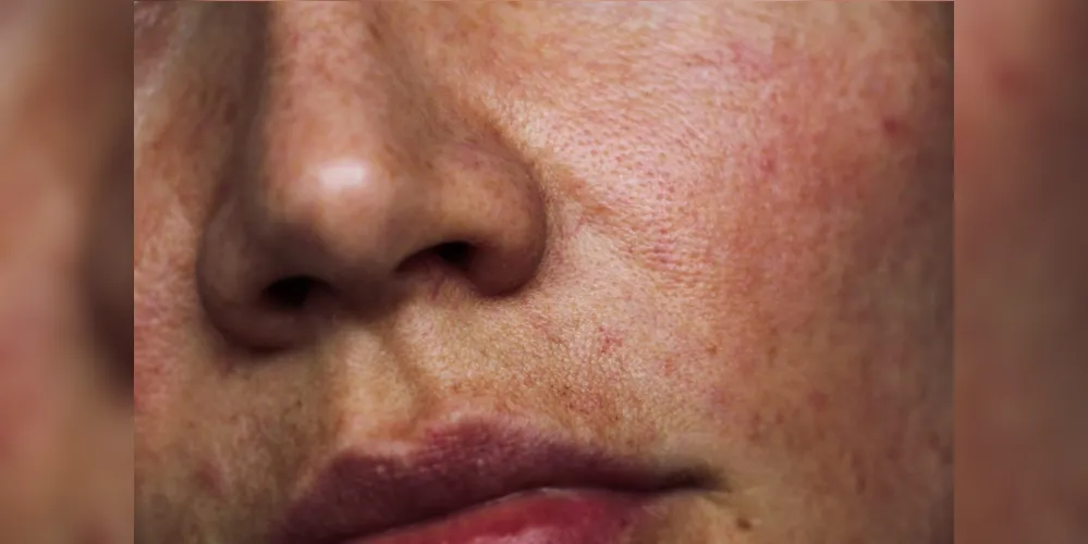 Doutora fala sobre os cuidados para evitar o melasma no rosto