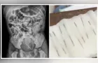 Menino de 2 anos passa por cirurgia após engolir oito agulhas