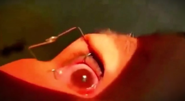 More than 60 larvae were removed from a woman’s eyes during surgery