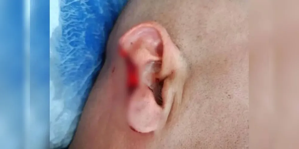 Parte da orelha do policial foi arrancada