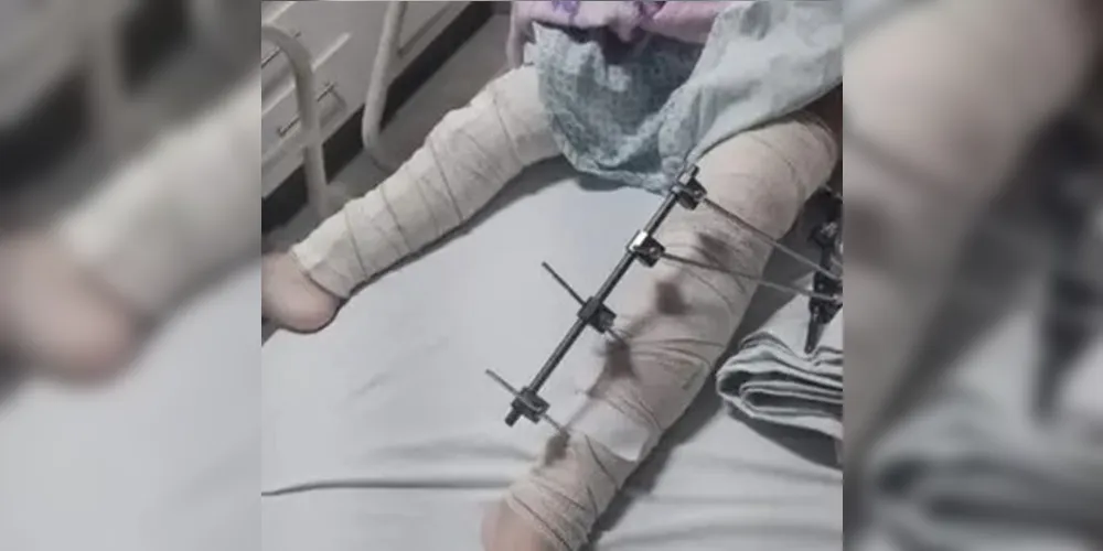 Criança foi submetida a um procedimento cirúrgico na perna errada