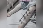 Após fazerem cirurgia na perna errada de criança, médicos são afastados
