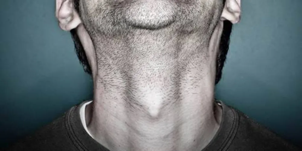 Imagem ilustrativa da imagem Homens também são propensos ao câncer de tireoide