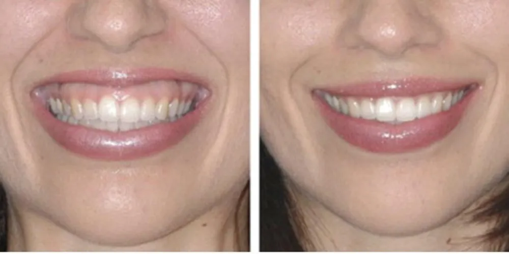 Imagem ilustrativa da imagem Botox pode ser utilizado em tratamentos odontológicos
