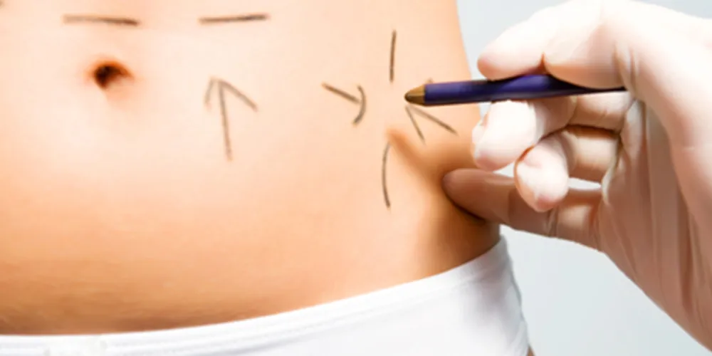 Imagem ilustrativa da imagem Lipoaspiração não é alternativa para emagrecimento