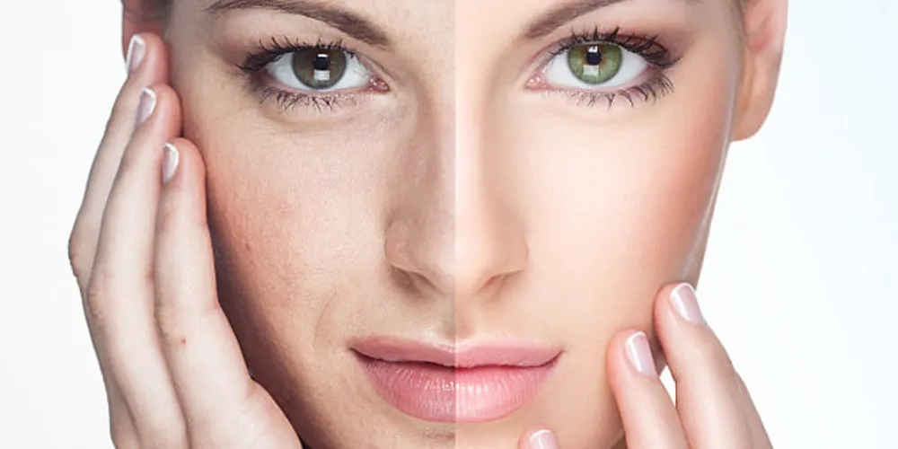 Imagem ilustrativa da imagem Terapias são combinadas para tratar o melasma