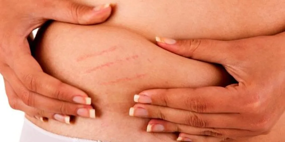 Imagem ilustrativa da imagem Estrias: saiba como tratar uma das maiores vilãs da estética feminina