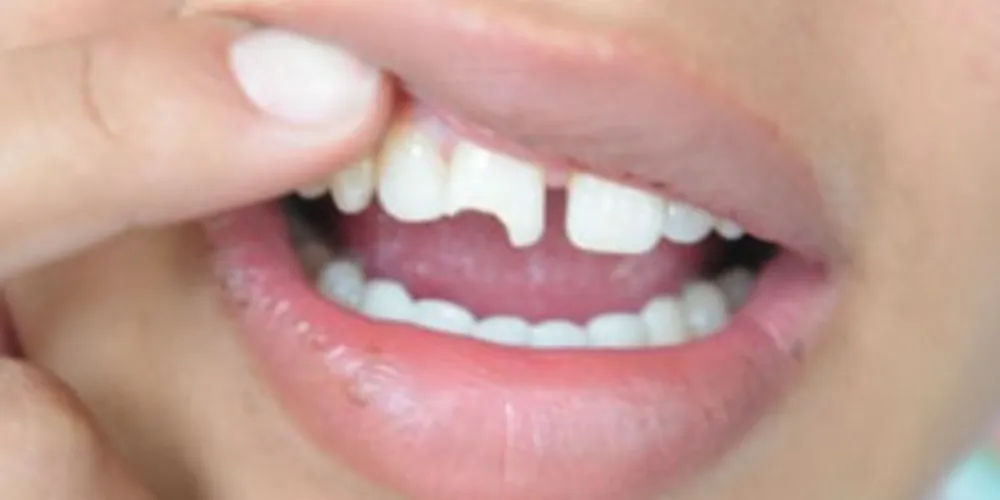 Imagem ilustrativa da imagem No inverno, aumenta a incidência da quebra de dentes