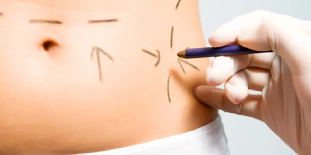 Imagem ilustrativa da imagem Mitos e verdades da lipoaspiração