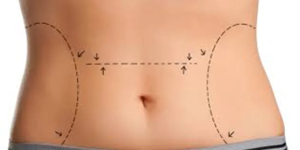 Imagem ilustrativa da imagem  Verão: belos corpos esculpidos pela cirurgia plástica