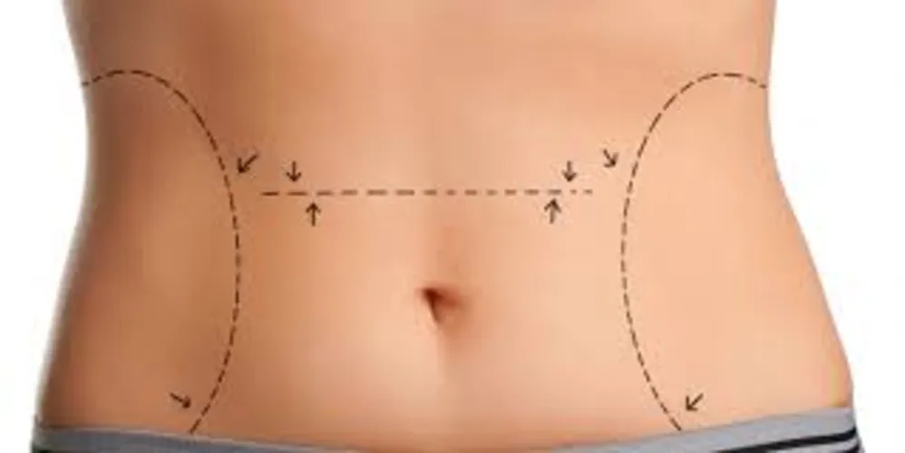 Imagem ilustrativa da imagem  Verão: belos corpos esculpidos pela cirurgia plástica