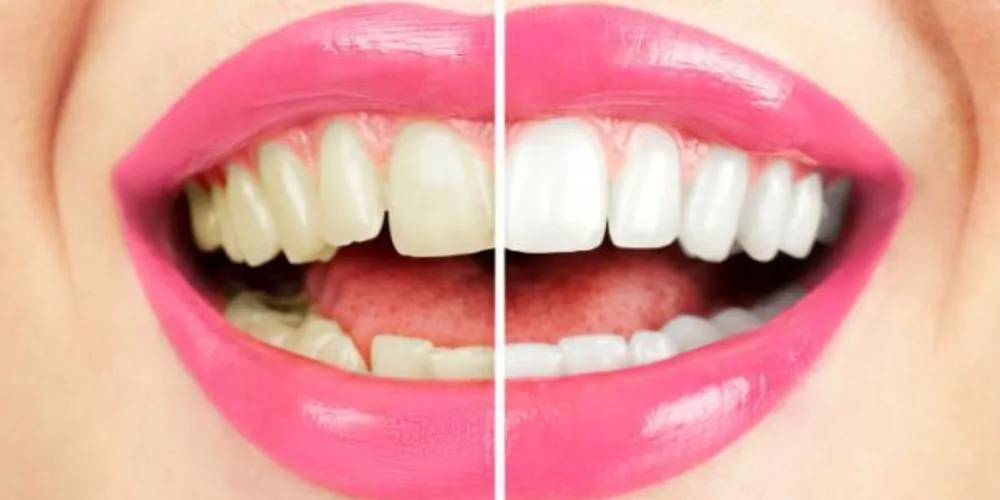 Imagem ilustrativa da imagem Alimentação errada pode escurecer os dentes