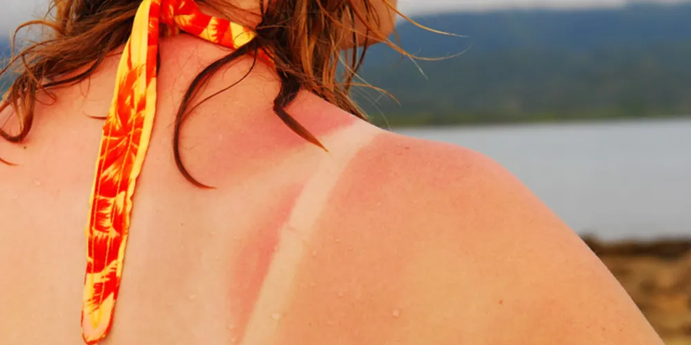 Imagem ilustrativa da imagem Câncer de Pele - Dicas que podem salvar vidas no Carnaval