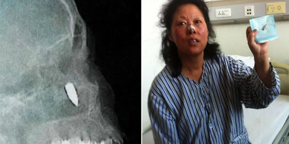 Imagem ilustrativa da imagem Mulher passa 48 anos com bala na cabeça sem saber que foi baleada