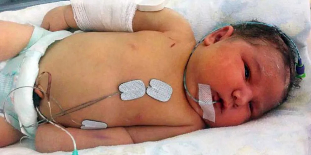 Imagem ilustrativa da imagem Médico quebra braço de bebê para salvar sua vida no parto