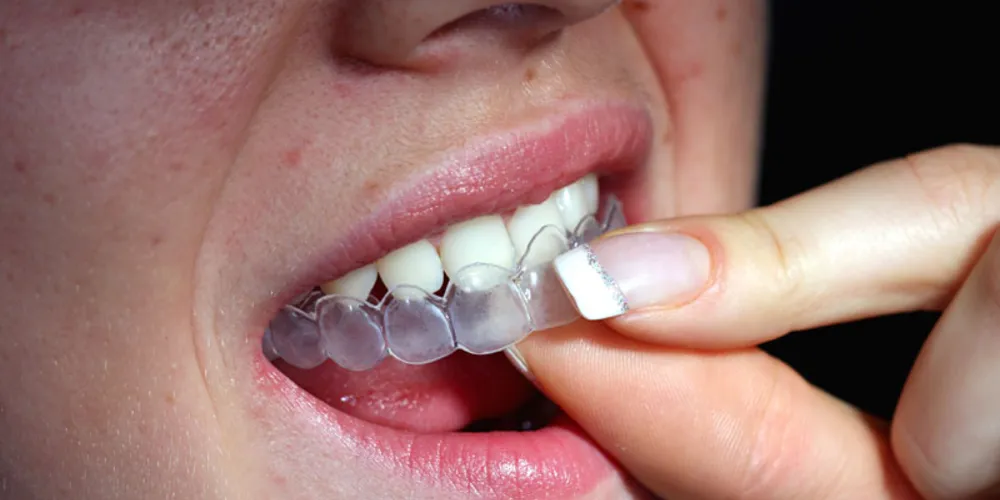 Imagem ilustrativa da imagem Anvisa propõe restrições na venda de clareadores dentais