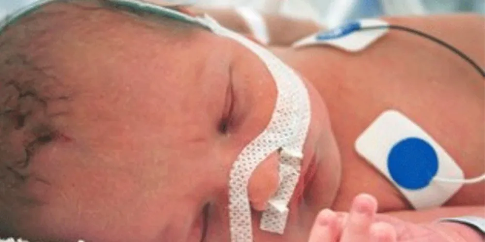 Imagem ilustrativa da imagem Vírus respiratório ameaça saúde de bebês prematuros