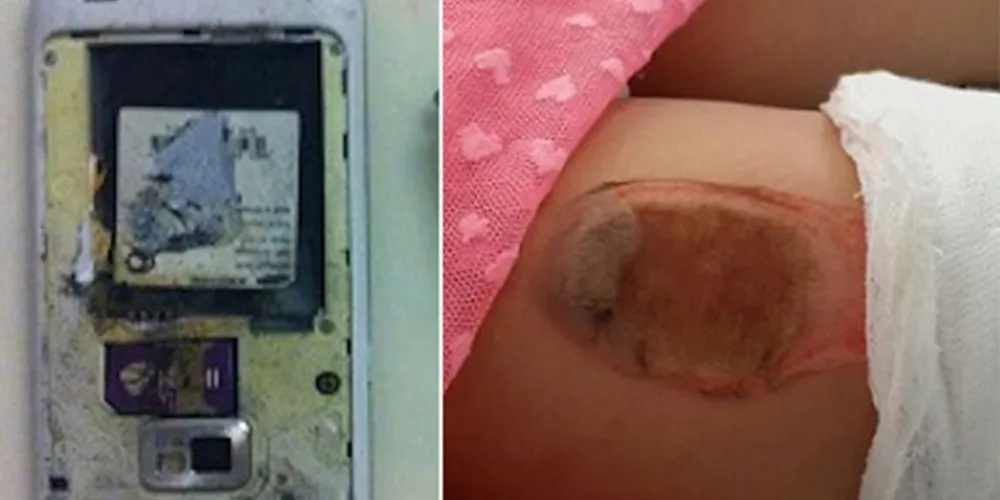 Imagem ilustrativa da imagem Menina fica queimada após celular explodir em seu bolso