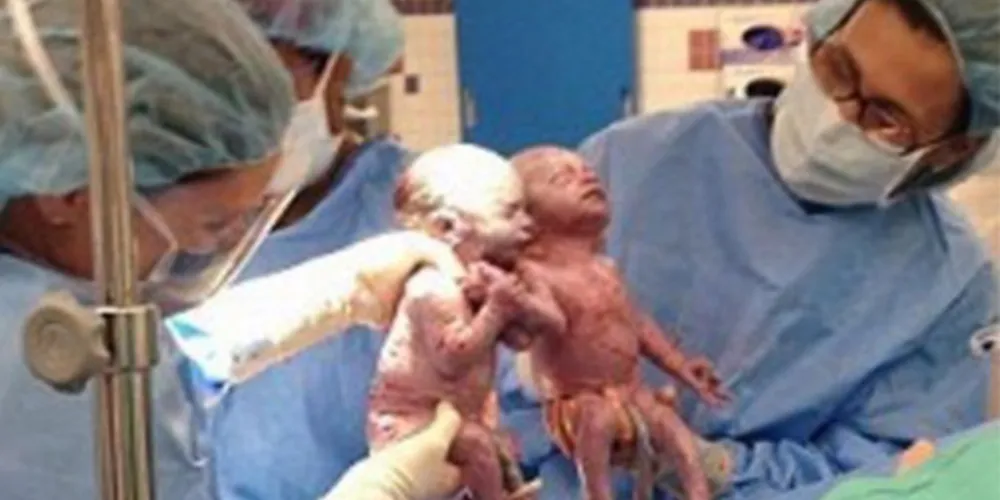 Imagem ilustrativa da imagem Gêmeas nascem de mãos dadas e comovem médicos