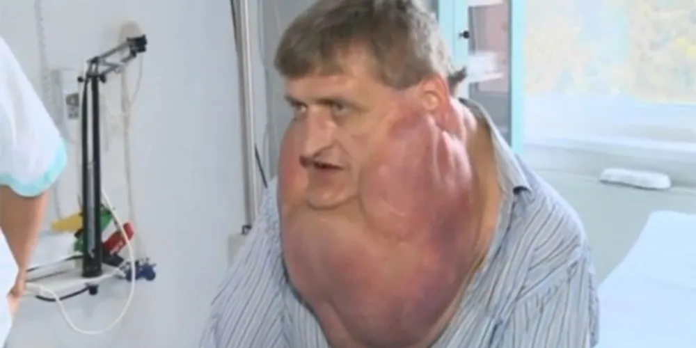 Imagem ilustrativa da imagem Homem retira tumor de treze quilos do rosto