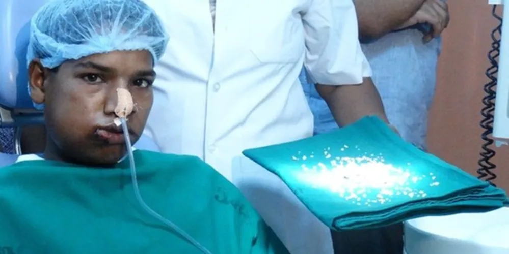 Imagem ilustrativa da imagem Médicos removem 232 dentes da boca de adolescente na Índia