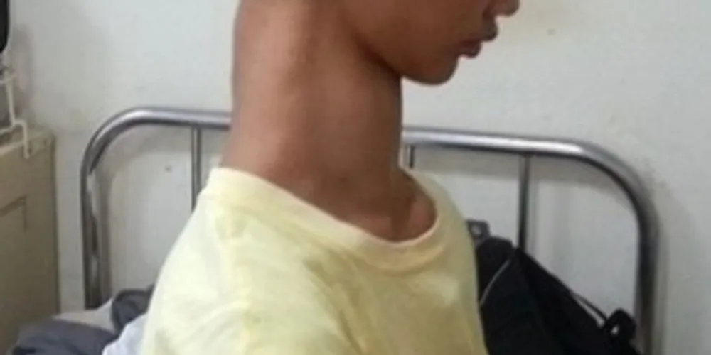 Imagem ilustrativa da imagem Adolescente com 'pescoço de girafa' deve passar por cirurgia