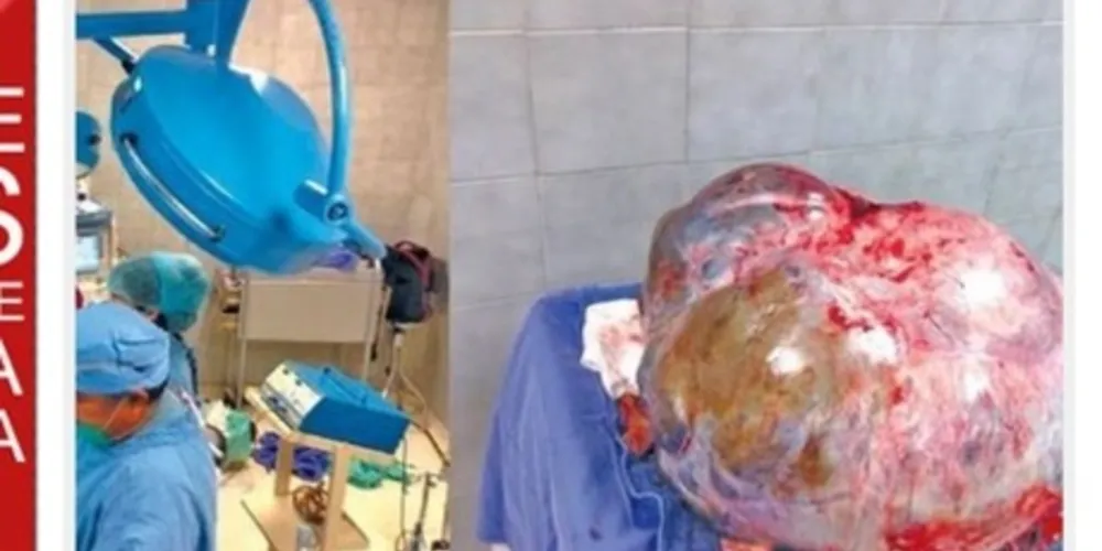 Imagem ilustrativa da imagem Mulher sobrevive após retirar tumor de 60kg do ovário