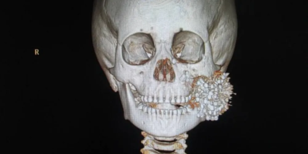 Imagem ilustrativa da imagem Médicos removem 325 chumbinhos do rosto de garoto chinês