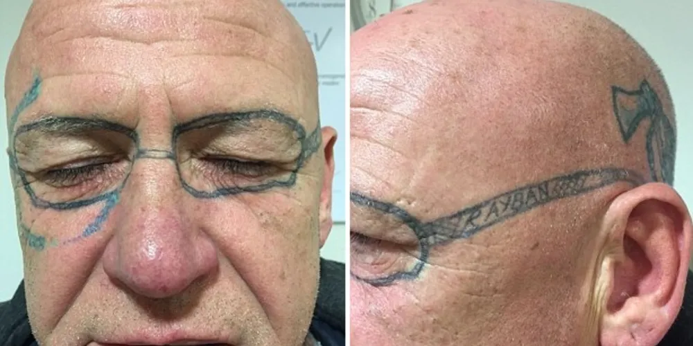 Imagem ilustrativa da imagem Após bebedeira, homem acorda com ‘óculos’ tatuado no rosto