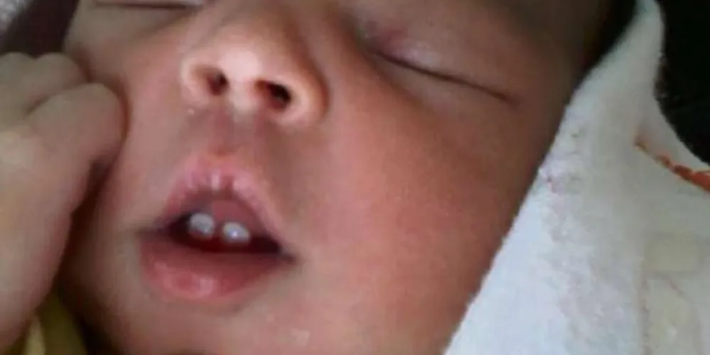 Imagem ilustrativa da imagem Bebê nasce com dois dentes no ES e surpreende médicos